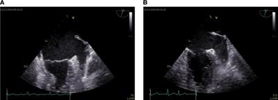 The value of left atrial longitudinal strain in evaluating left atrial appendage spontaneous echo contrast in non-valvular atrial fibrillation